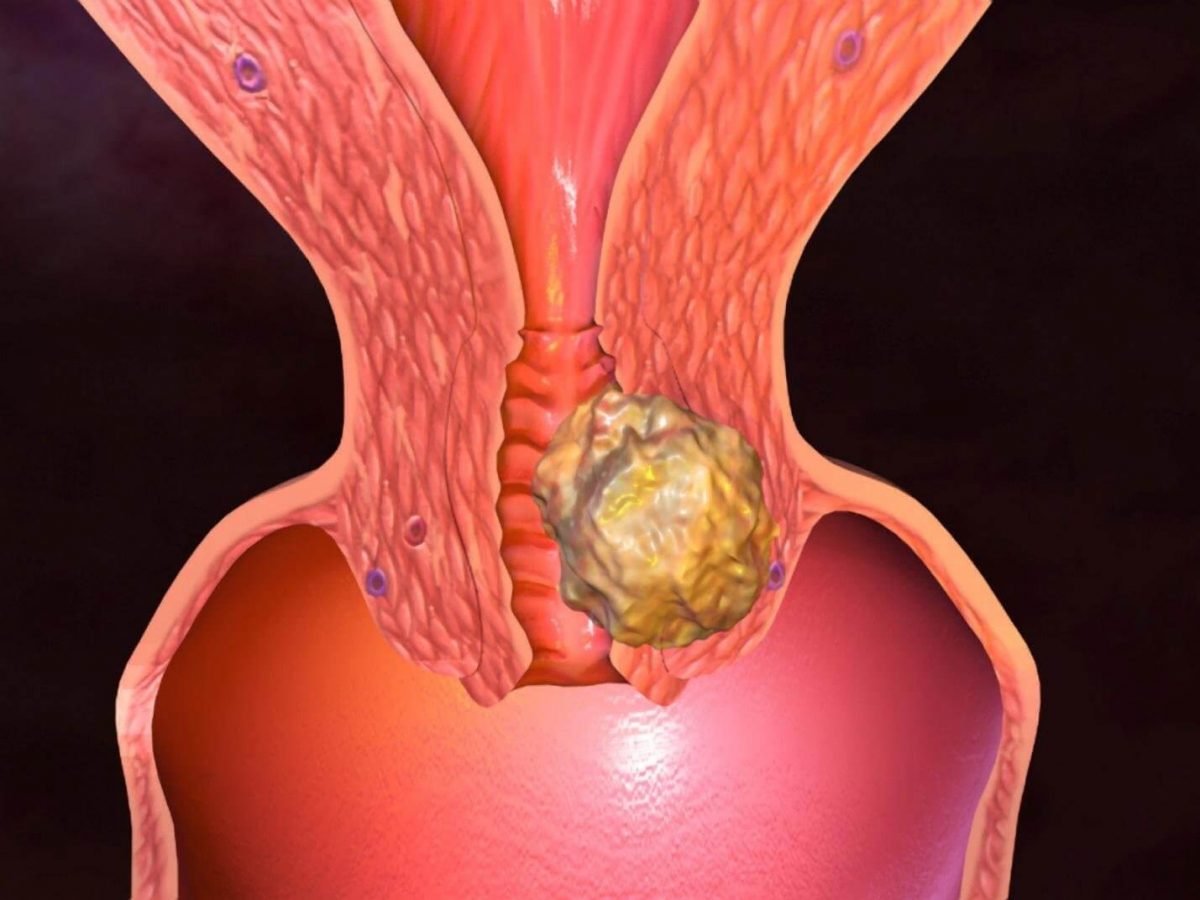 Рак матки: симптоми і скринінг